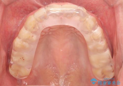 ナイトガードで歯ぎしりの影響を抑えるの治療後