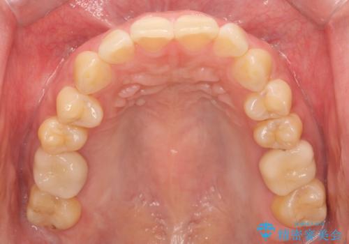 ナイトガードで歯ぎしりの影響を抑えるの治療前