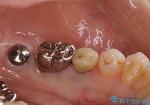 毎食後物がつまる! インプラント治療の治療中