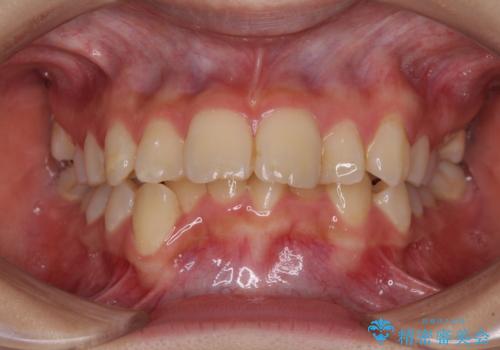 【モニター】出っ歯と八重歯　抜歯矯正でスッキリとした口元にの症例 治療前