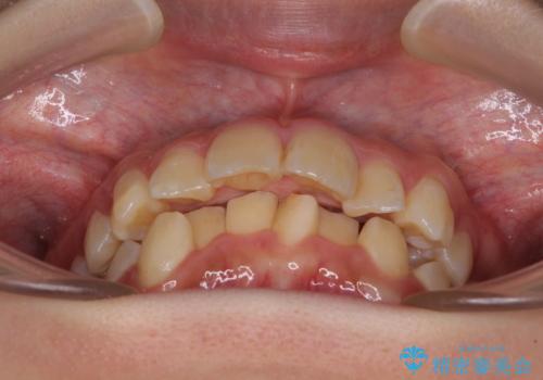 【モニター】出っ歯と八重歯　抜歯矯正でスッキリとした口元にの治療前