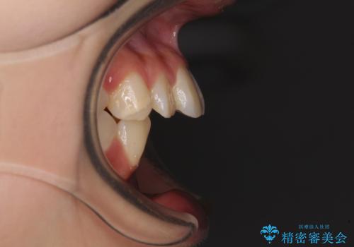 【モニター】出っ歯と八重歯 抜歯矯正でスッキリとした口元にの治療前