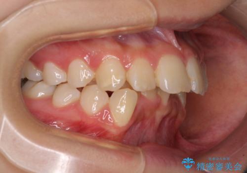 【モニター】出っ歯と八重歯 抜歯矯正でスッキリとした口元にの治療前