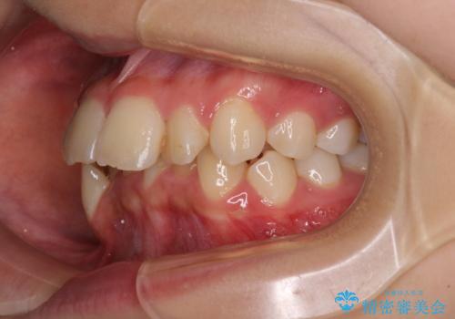 【モニター】出っ歯と八重歯 抜歯矯正でスッキリとした口元にの治療前