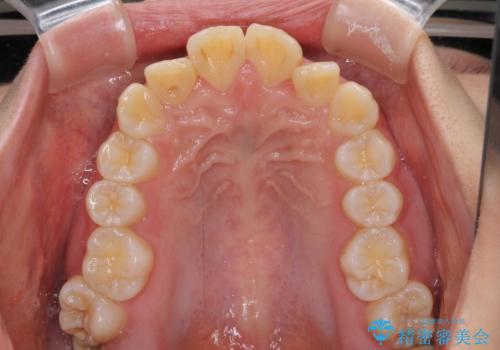 【モニター】出っ歯と八重歯 抜歯矯正でスッキリとした口元にの治療前