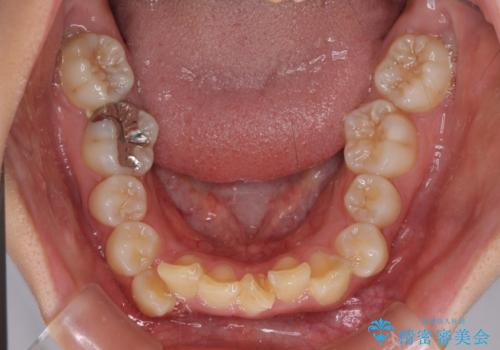 【モニター】出っ歯と八重歯 抜歯矯正でスッキリとした口元にの治療前