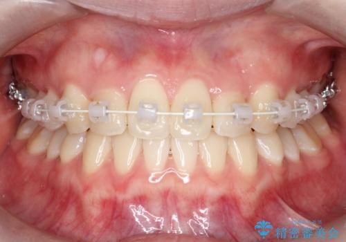 インビザラインとワイヤー矯正の併用で綺麗な歯並びに!の治療中