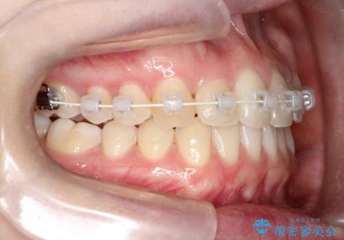 インビザラインとワイヤー矯正の併用で綺麗な歯並びに!の治療中