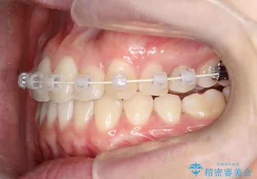 インビザラインとワイヤー矯正の併用で綺麗な歯並びに!の治療中