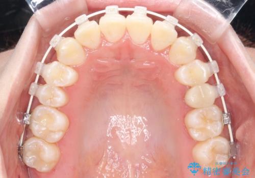 インビザラインとワイヤー矯正の併用で綺麗な歯並びに!の治療中