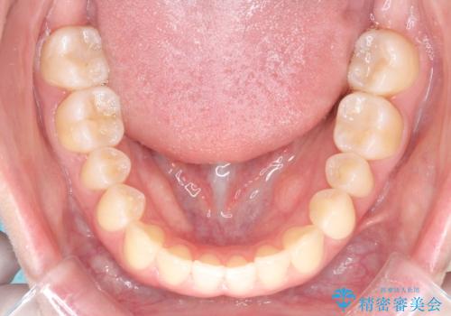 インビザラインとワイヤー矯正の併用で綺麗な歯並びに!の治療中