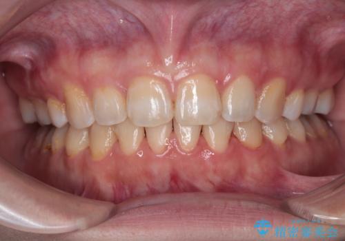 外科手術が必要と言えるほど突出した前歯　長期間をかけた抜歯矯正の症例 治療後