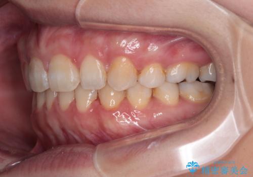 外科手術が必要と言えるほど突出した前歯　長期間をかけた抜歯矯正の治療後