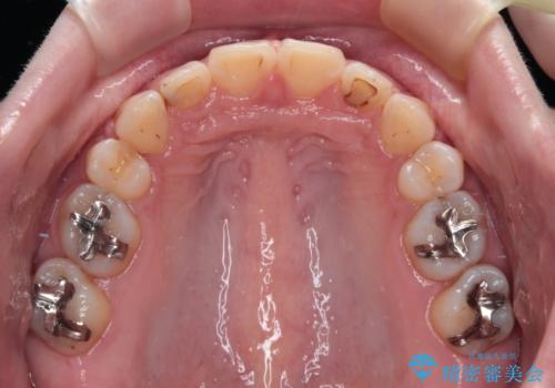 外科手術が必要と言えるほど突出した前歯　長期間をかけた抜歯矯正の治療後