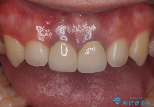 前歯の変色 神経のない歯の再治療の治療後