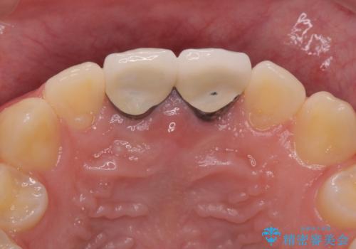 前歯の変色　神経のない歯の再治療の治療後