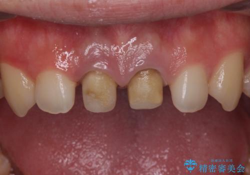 前歯の変色 神経のない歯の再治療の治療中