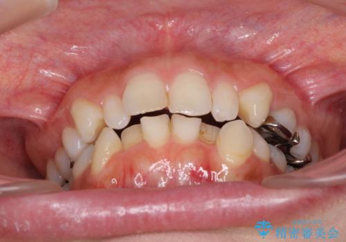痛むむし歯と小さい歯とデコボコ　むし歯治療と矯正治療を並行した総合歯科治療の治療前