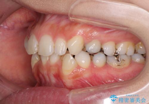痛むむし歯と小さい歯とデコボコ　むし歯治療と矯正治療を並行した総合歯科治療の治療前