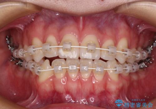 咬み合わせの乱れを改善 ワイヤー装置で楽々矯正治療の治療中