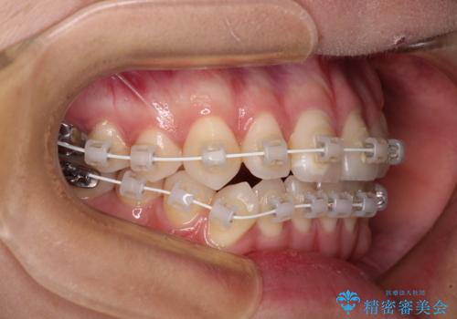 咬み合わせの乱れを改善 ワイヤー装置で楽々矯正治療の治療中