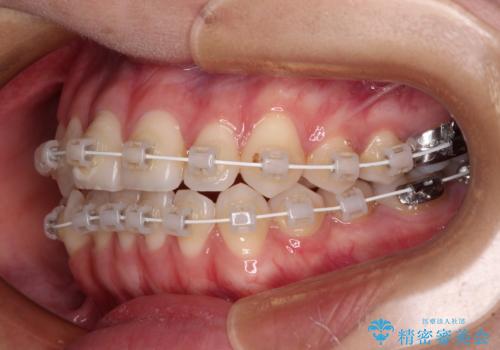 咬み合わせの乱れを改善 ワイヤー装置で楽々矯正治療の治療中