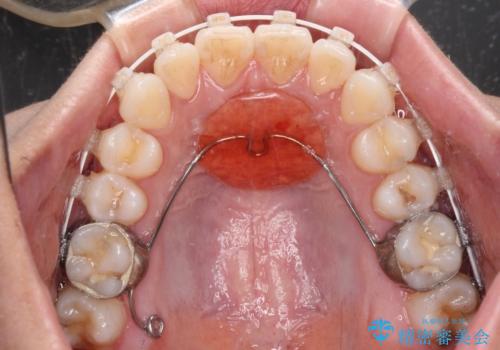 咬み合わせの乱れを改善 ワイヤー装置で楽々矯正治療の治療中