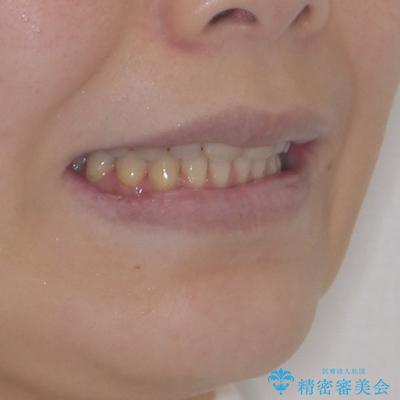 外科手術が必要と言えるほど突出した前歯　長期間をかけた抜歯矯正の治療後（顔貌）