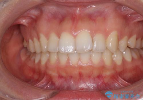 インビザライン矯正で前歯のデコボコを改善の症例 治療前