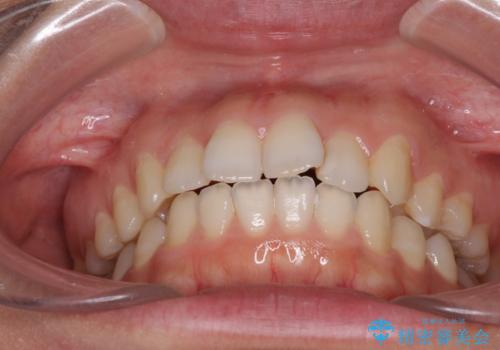 インビザライン矯正で前歯のデコボコを改善の治療前
