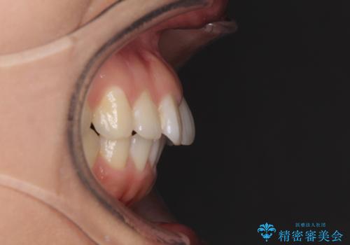 インビザライン矯正で前歯のデコボコを改善の治療前