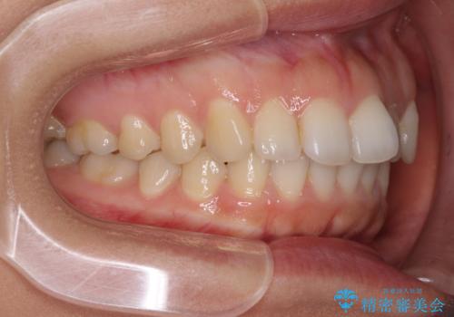 インビザライン矯正で前歯のデコボコを改善の治療前