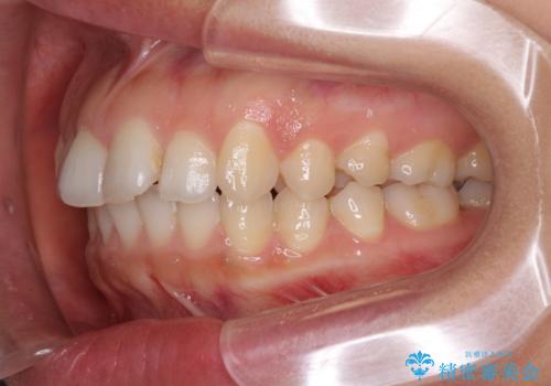 インビザライン矯正で前歯のデコボコを改善の治療前