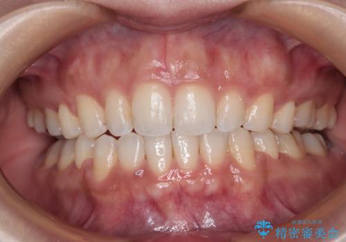 唇が閉じにくい ワイヤー装置での抜歯矯正の症例 治療後