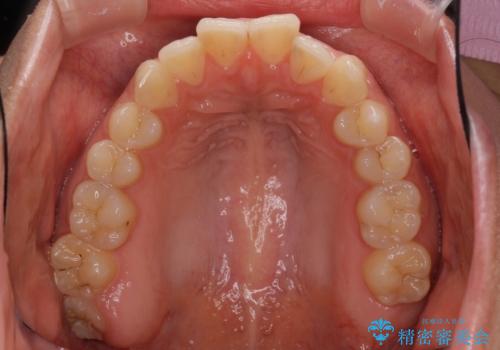 インビザライン矯正で前歯のデコボコを改善の治療前