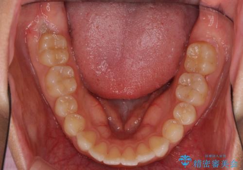 インビザライン矯正で前歯のデコボコを改善の治療前