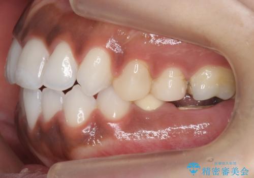 奥歯の高さがない　20代で入れ歯もインプラントも難しい　ブリッジで歯を残す治療の治療前