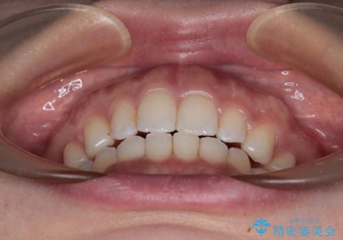 唇が閉じにくい ワイヤー装置での抜歯矯正の治療後