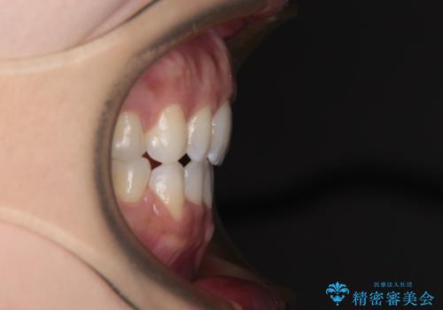 唇が閉じにくい　ワイヤー装置での抜歯矯正の治療後