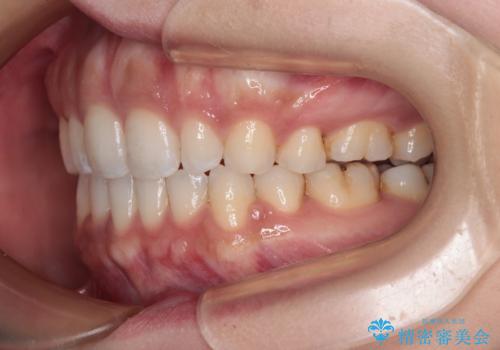 唇が閉じにくい ワイヤー装置での抜歯矯正の治療後