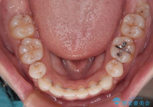 唇が閉じにくい ワイヤー装置での抜歯矯正の治療後