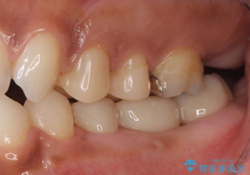 奥歯の高さがない　20代で入れ歯もインプラントも難しい　ブリッジで歯を残す治療の治療後