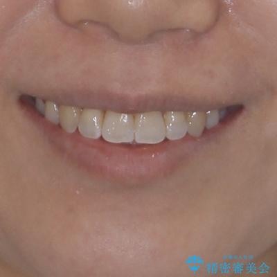 気になる八重歯 ワイヤー装置での非抜歯矯正の治療後(顔貌)