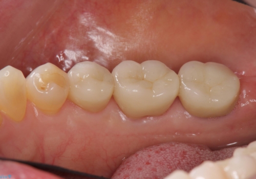 奥歯の高さがない 歯周外科で解決の症例 治療後