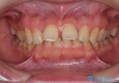 外科手術が必要と言えるほど突出した前歯　長期間をかけた抜歯矯正の症例 治療前