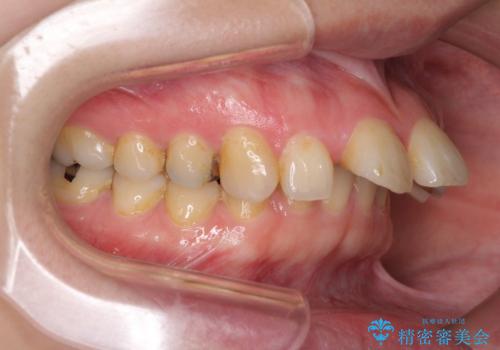 外科手術が必要と言えるほど突出した前歯　長期間をかけた抜歯矯正の治療前