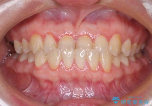 反対咬合を治したい ワイヤー装置で一気に咬み合わせを改善の治療前