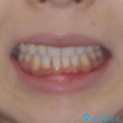 唇が閉じにくい ワイヤー装置での抜歯矯正の治療後(顔貌)