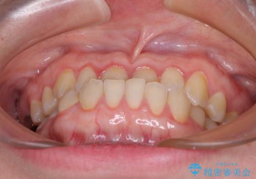 反対咬合を治したい ワイヤー装置で一気に咬み合わせを改善の治療前