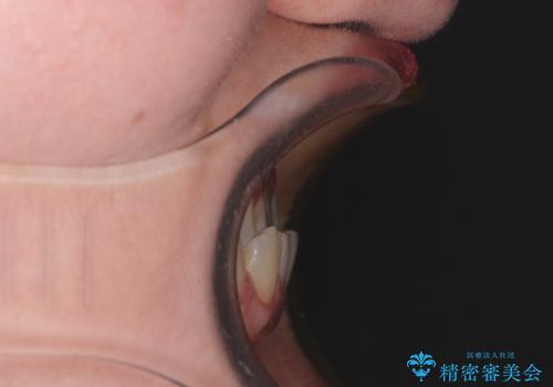 反対咬合を治したい ワイヤー装置で一気に咬み合わせを改善の治療前